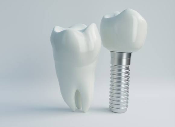 dental implant post with crown next to a natural tooth