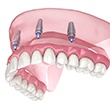 Implant dentures in Waverly