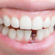 person smiling with a dental implant abutment visible