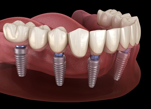 3D illustration of an implant denture