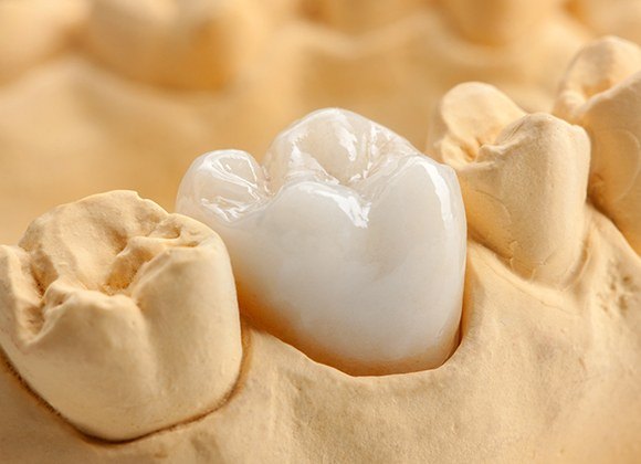 dental crown on model