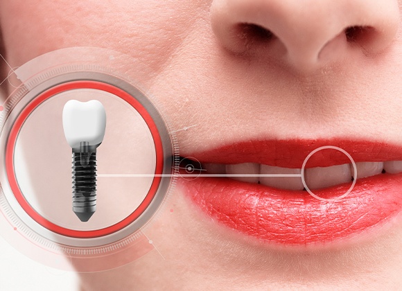 smile with implant animation in a circle