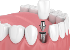 Single dental implant special coupon