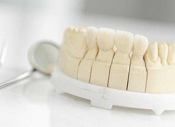 dental bridge on example smile