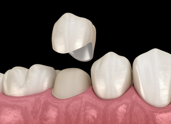 dental crown examples
