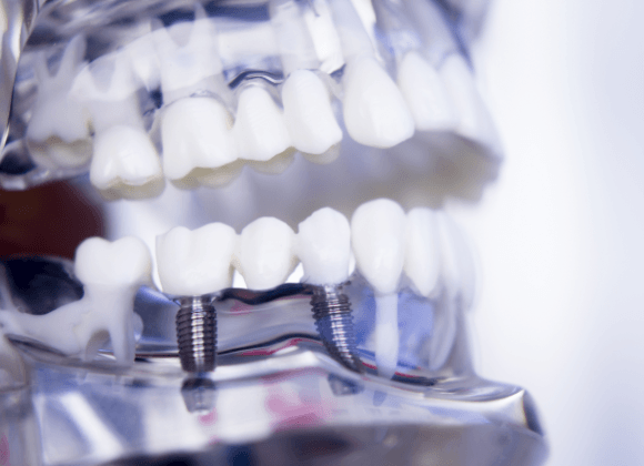 two dental implant posts supporting a dental bridge