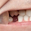 knocked out tooth