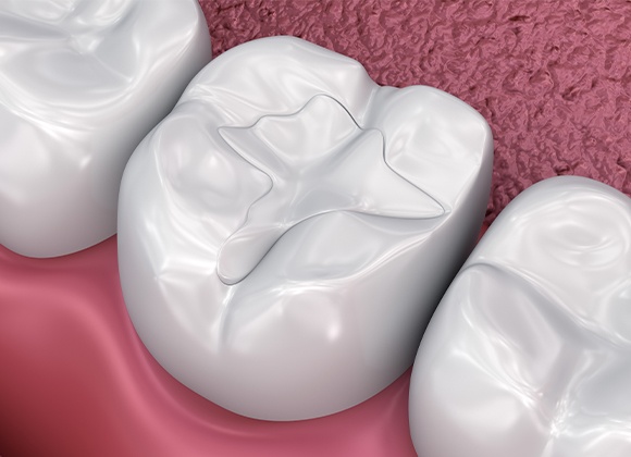 illustration of tooth colored fillings