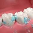 Illustration of fluoride