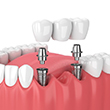dental bridge being placed over two dental implants 