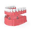 implant denture being placed on the lower arch