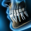 X-ray of a person with a dental implant