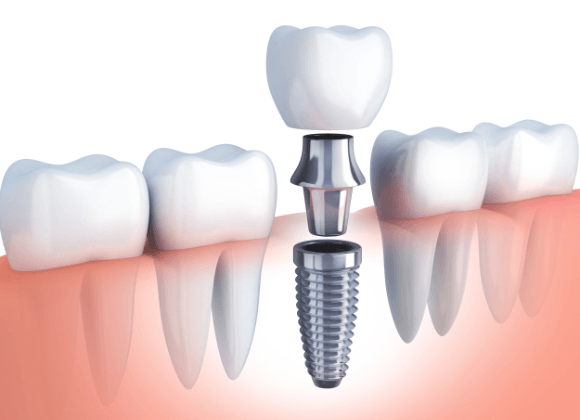 illustration of three parts of implant