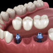 implant supported fixed bridge