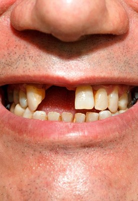 Man smiling to reveal front missing tooth