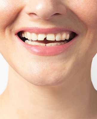 Fix a broken tooth near Nashua