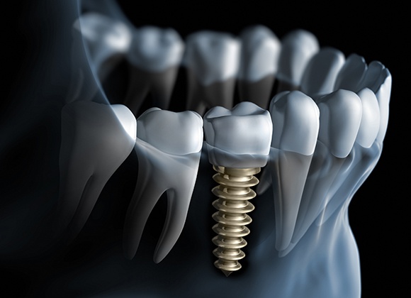 illustration of implant