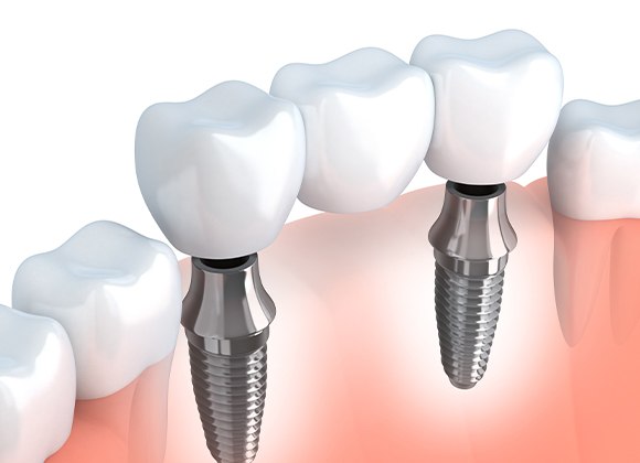 illustration of implant bridge