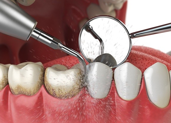 illustration of gum disease treatment