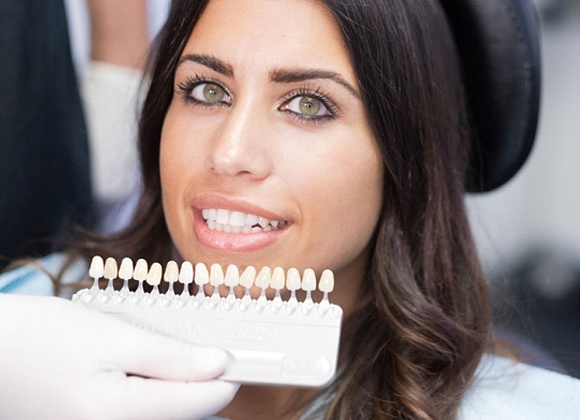 woman with porcelain veneers