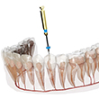 3D render of a root canal