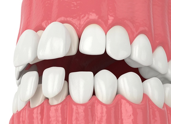 Illustration of porcelain veneers being placed on teeth