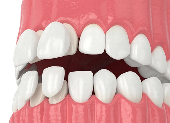 Illustration of porcelain veneers being placed on teeth