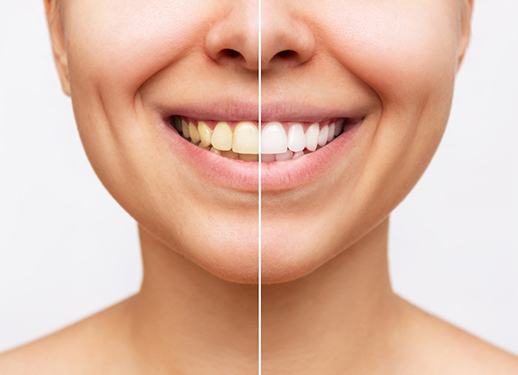 Closeup of patient's smile before and after teeth whitening