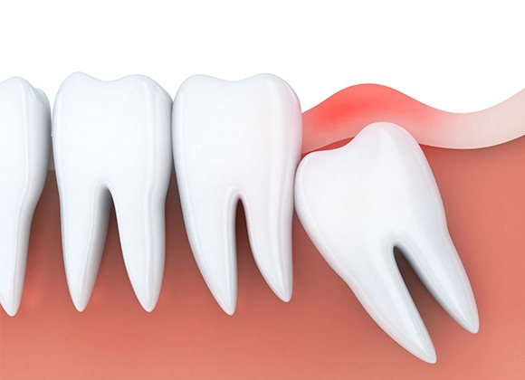 Animation of impacted teeth