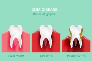 infographic of the two stages of gum disease in Waverly