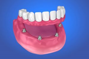 All-on-4 dental implants in Waverly 